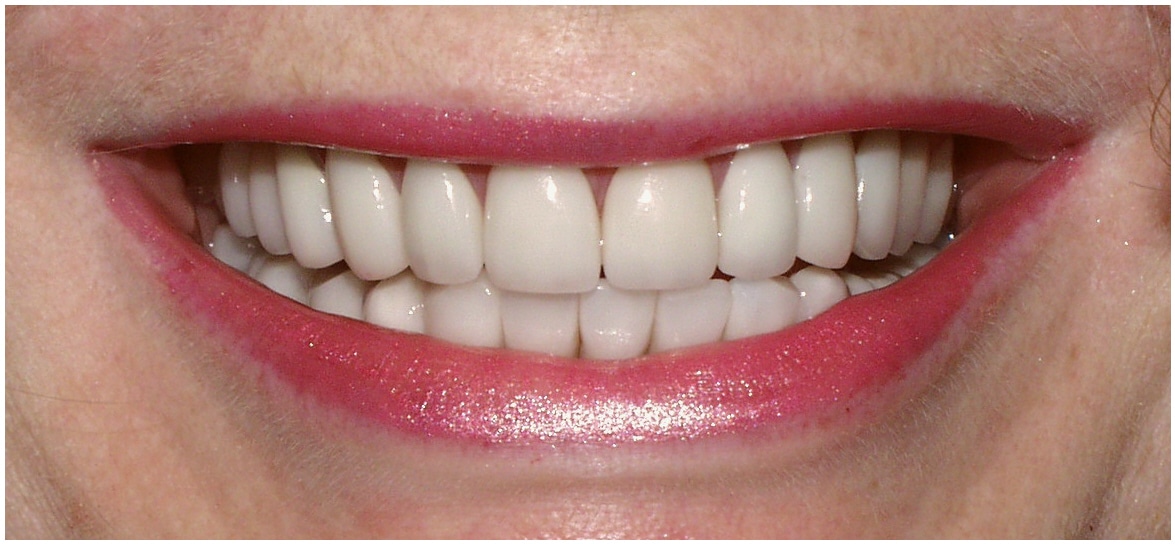 Porcelain Veneers