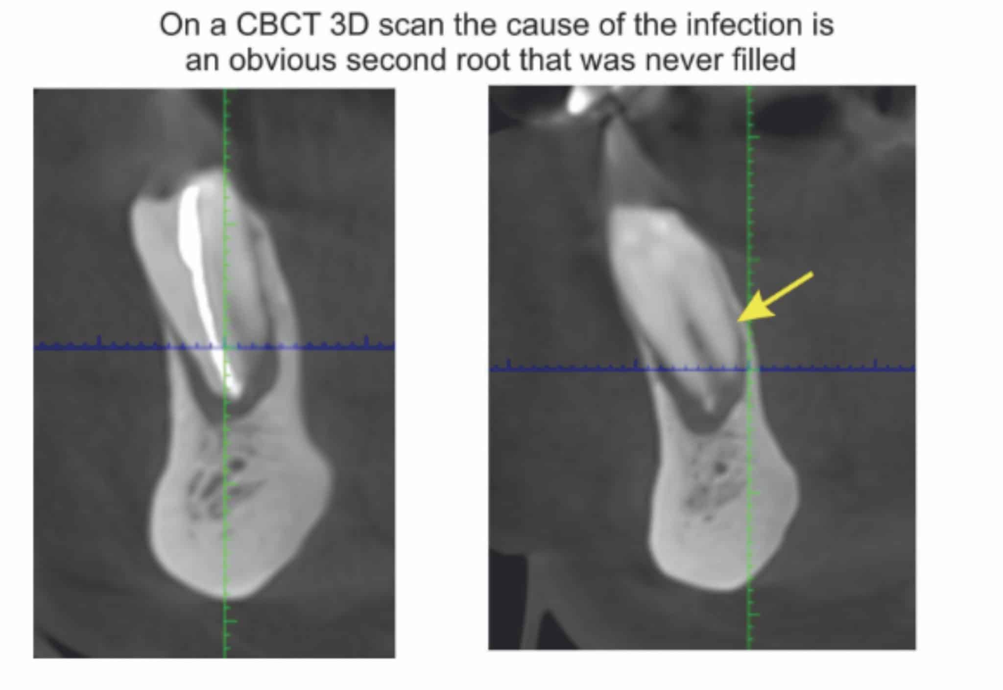 Three-dimensional CBCT dental scan showing an untreated second root in a lower premolar with persistent infection. Unlike a traditional dental X-ray, the CBCT reveals the hidden root responsible for the failed root canal, allowing accurate diagnosis and possible tooth preservation.